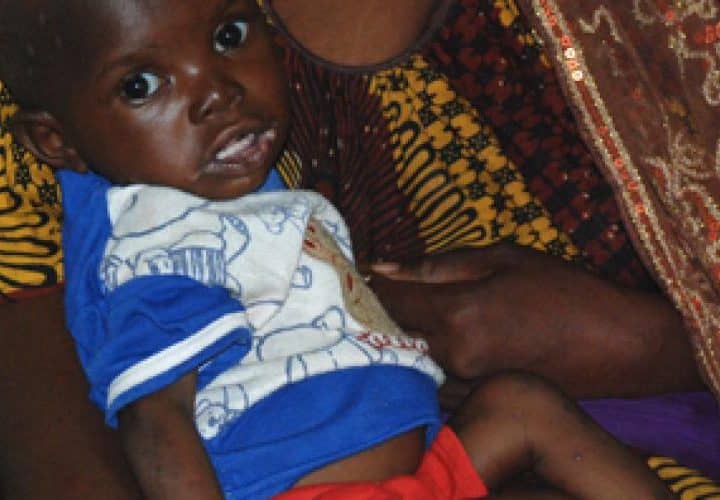 Enfant souffrant de malnutrition au Mali, illustrant les conséquences de la carence alimentaire